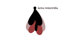 Clítoris removido